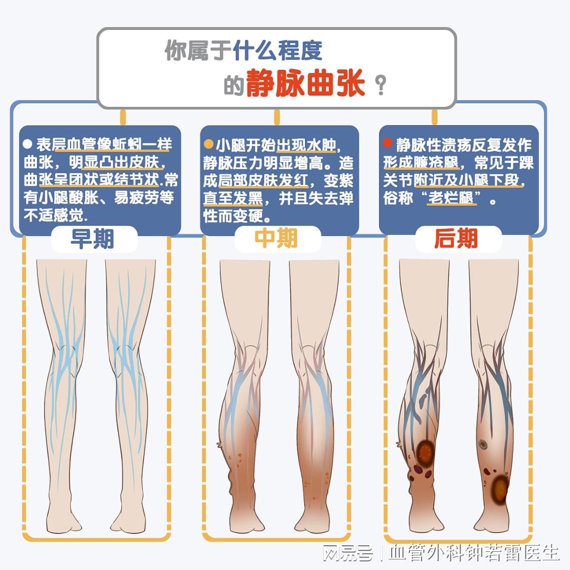 靜脈曲張最新療法，科技引領(lǐng)健康之路的新突破